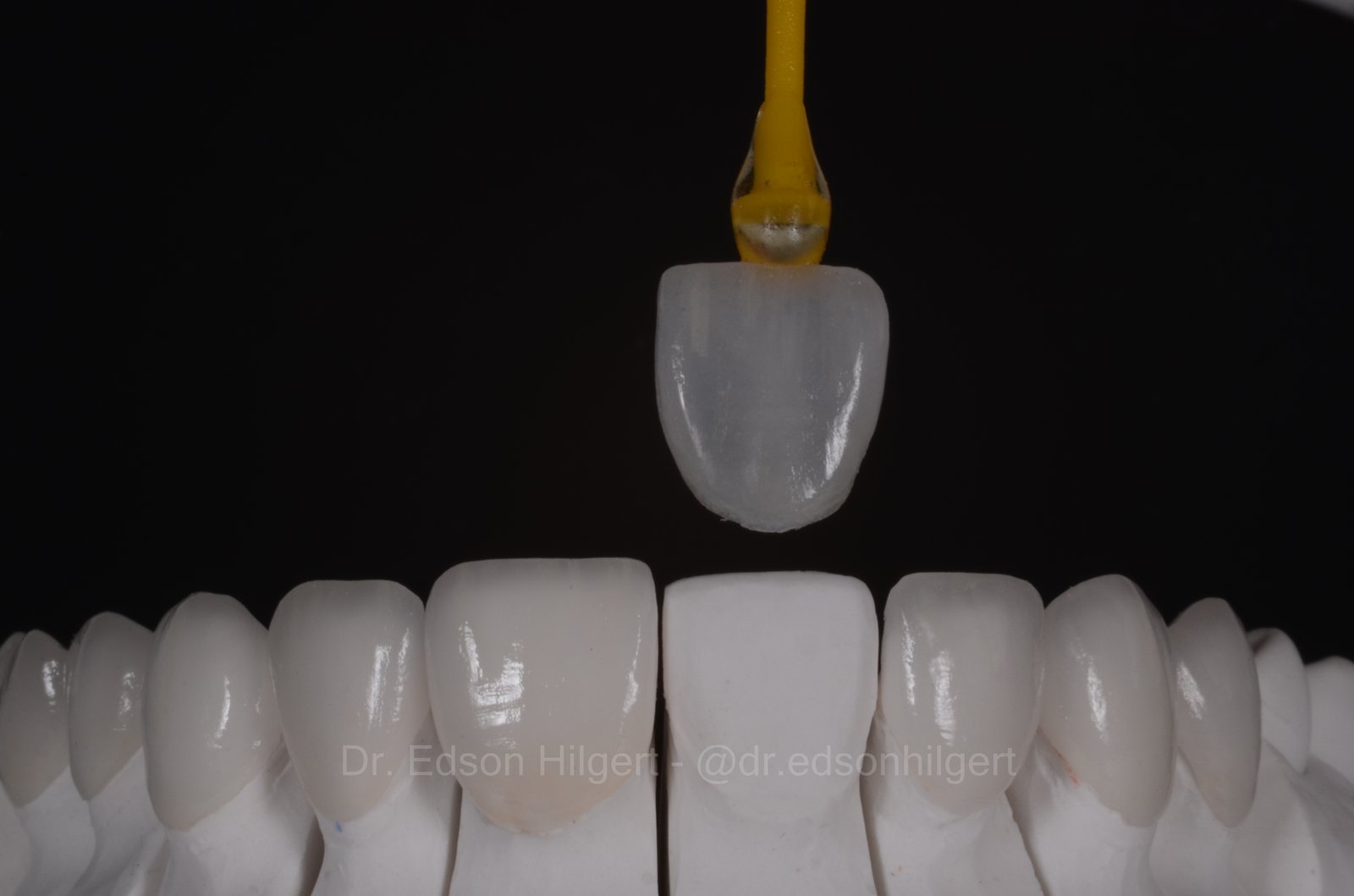 Lente de contato dental cerâmica sendo posicionada sobre modelo de dente — Dr. Edson Hilgert, São José dos Campos