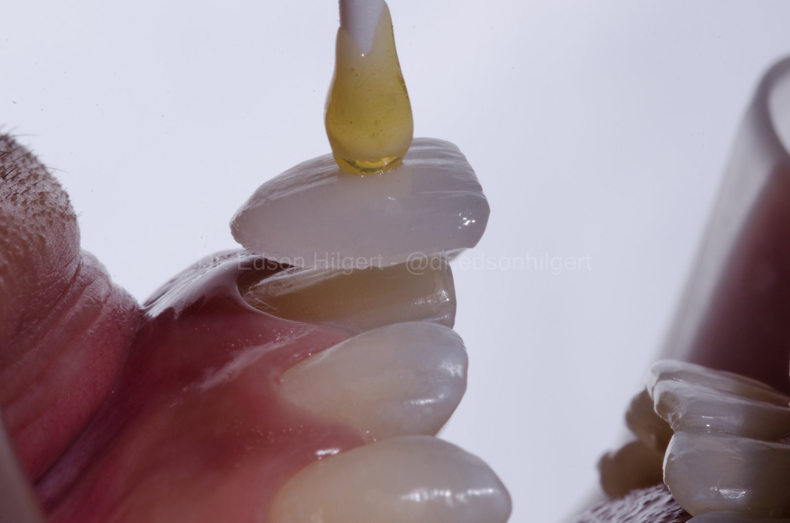 Fase de prova da lente de contato dental diretamente no dente do paciente — Dr. Edson Hilgert