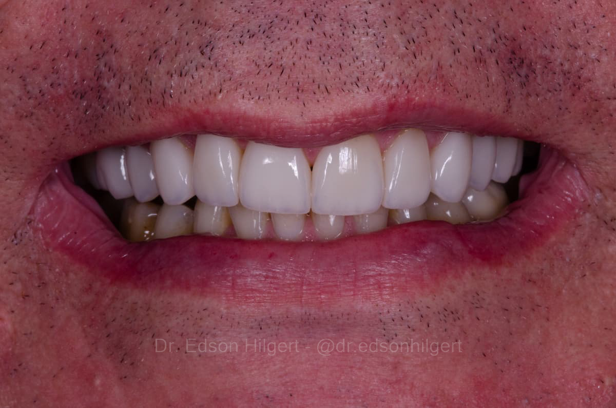Lentes de contato dentais — resultado final · Dr. Edson Hilgert SJC