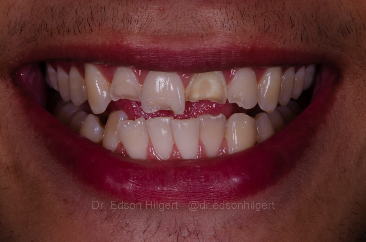 Antes — Dr. Edson Hilgert SJC