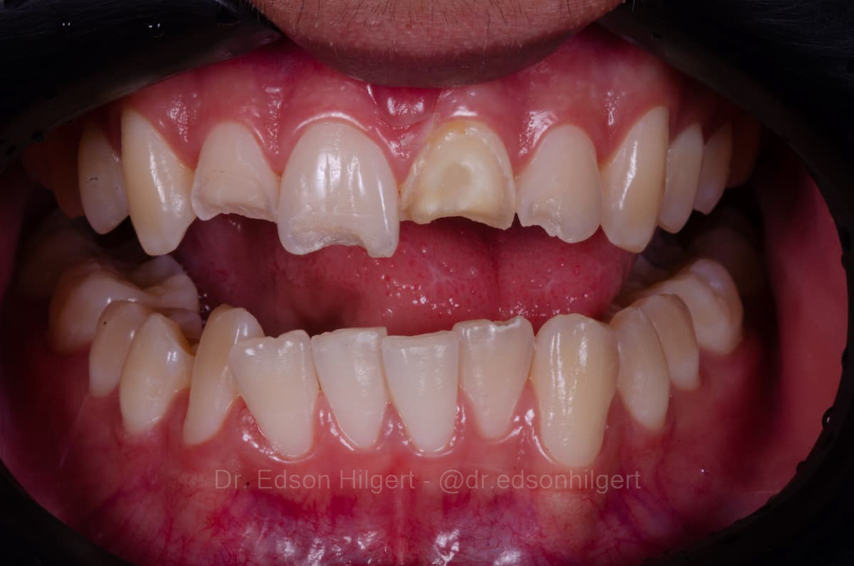 Caso 02 inicial — Dr. Edson Hilgert
