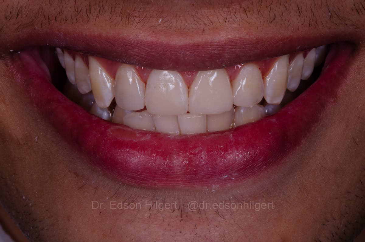 Reabilitação oral após trauma — resultado · Dr. Edson Hilgert SJC