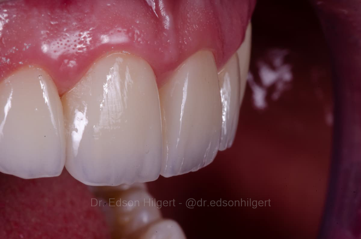 Caso 03 lateral close