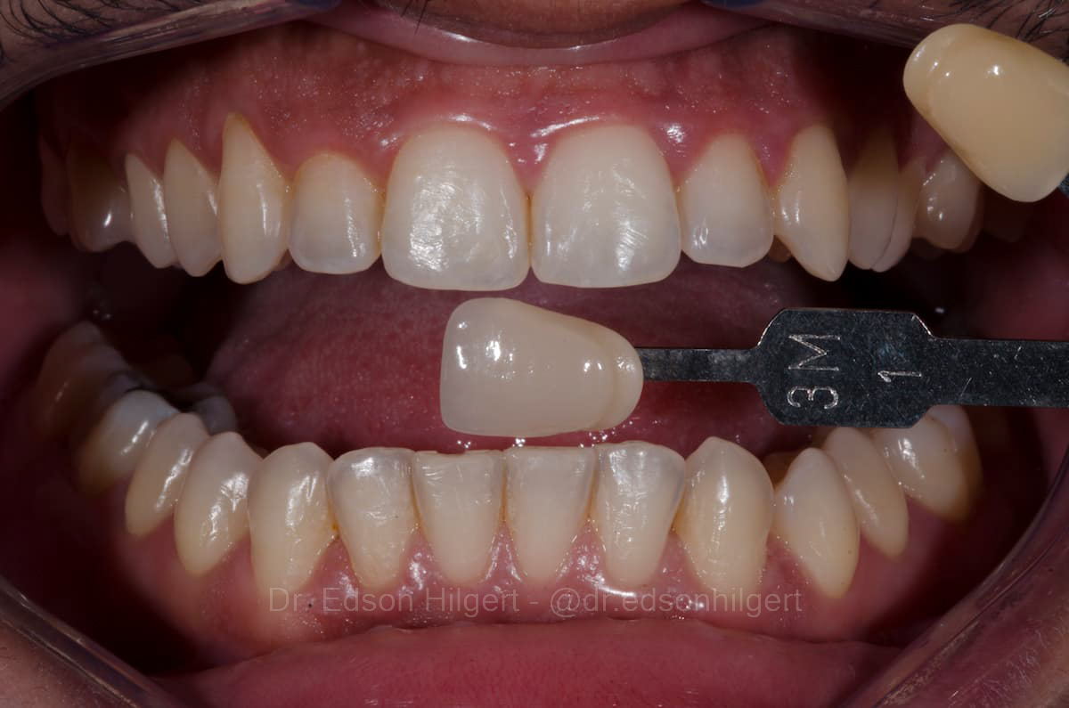 Antes — Dr. Edson Hilgert SJC