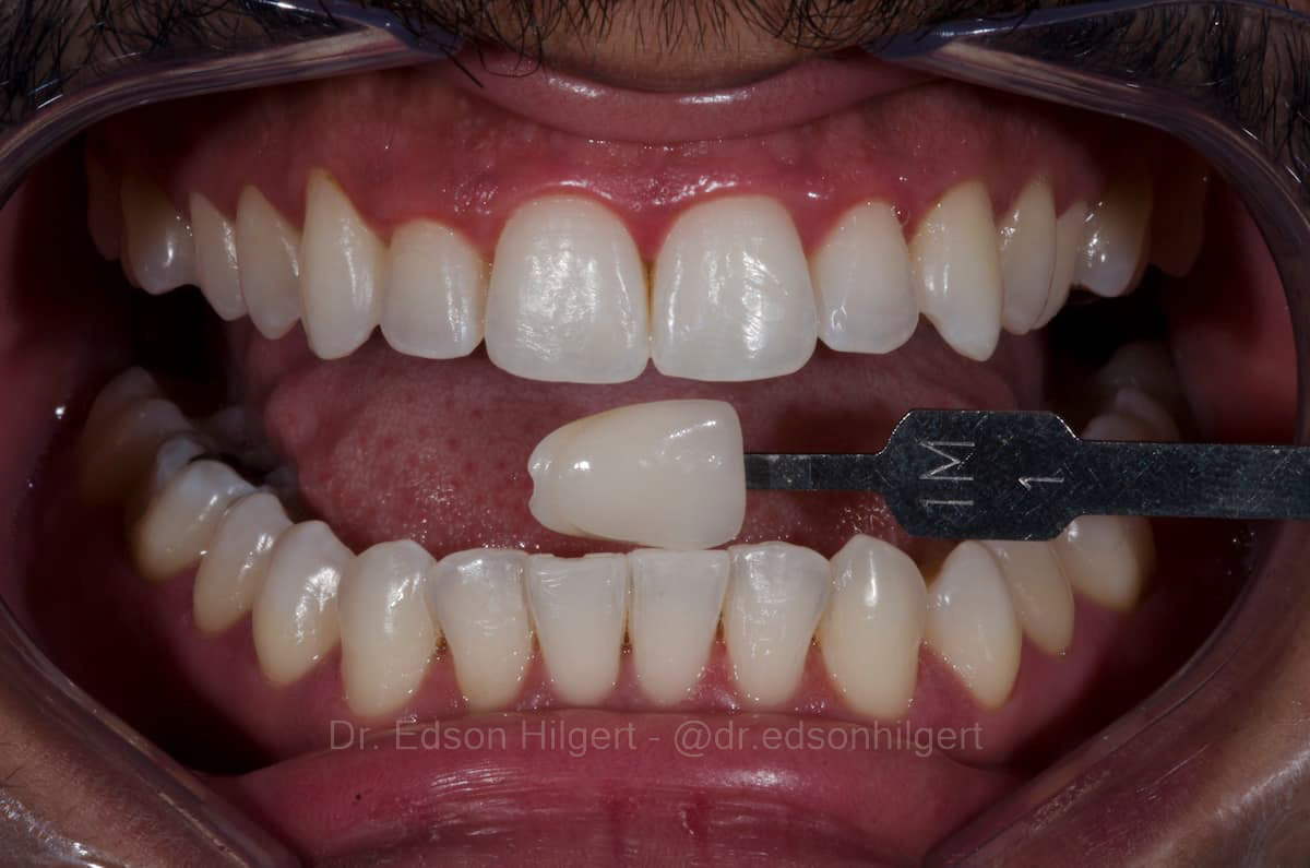 Depois — Dr. Edson Hilgert SJC