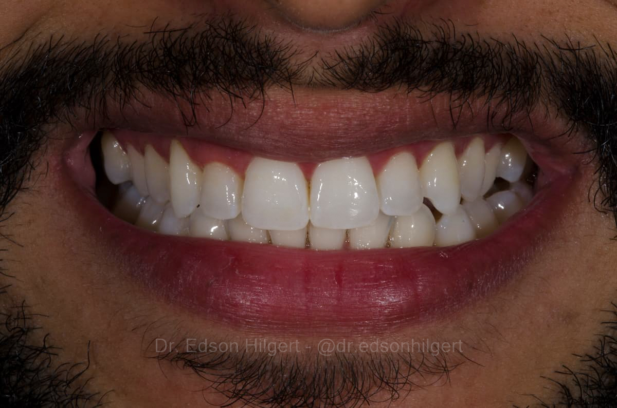 Clareamento dental resultado — Dr. Edson Hilgert SJC