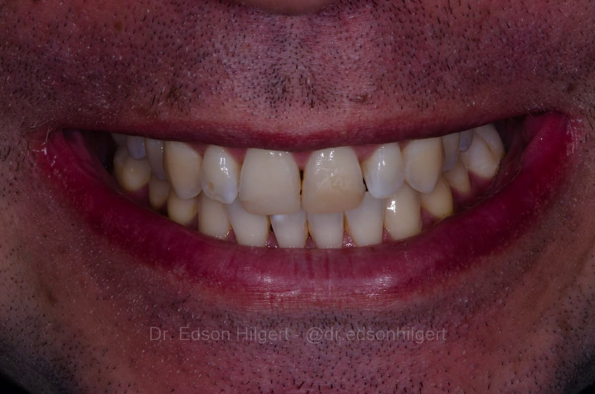 Antes — Dr. Edson Hilgert SJC