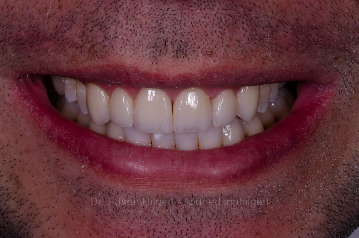 Lentes cerâmicas e clareamento — resultado · Dr. Edson Hilgert SJC
