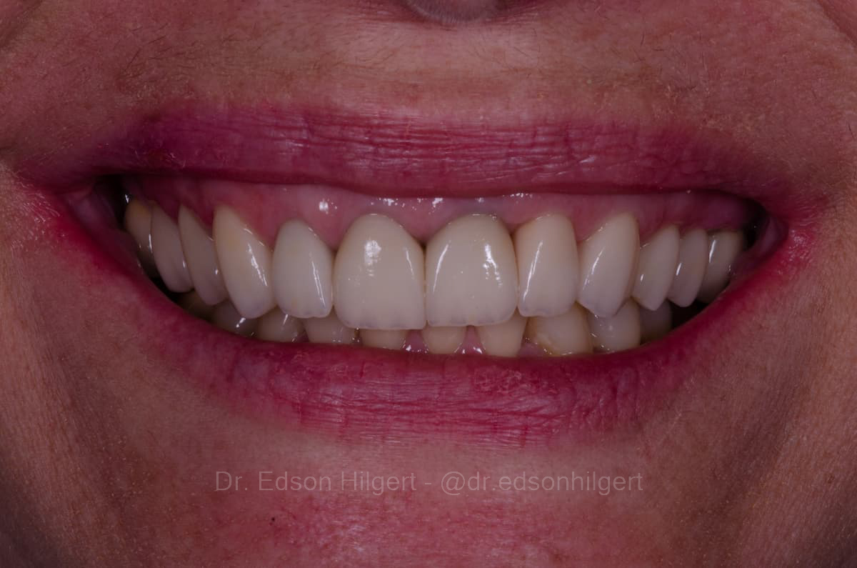 Reabilitação com coroas cerâmicas — resultado · Dr. Edson Hilgert SJC