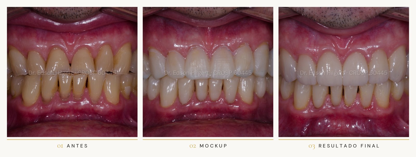 Caso real de planejamento digital do sorriso em São José dos Campos: antes, mockup e resultado final — Dr. Edson Hilgert