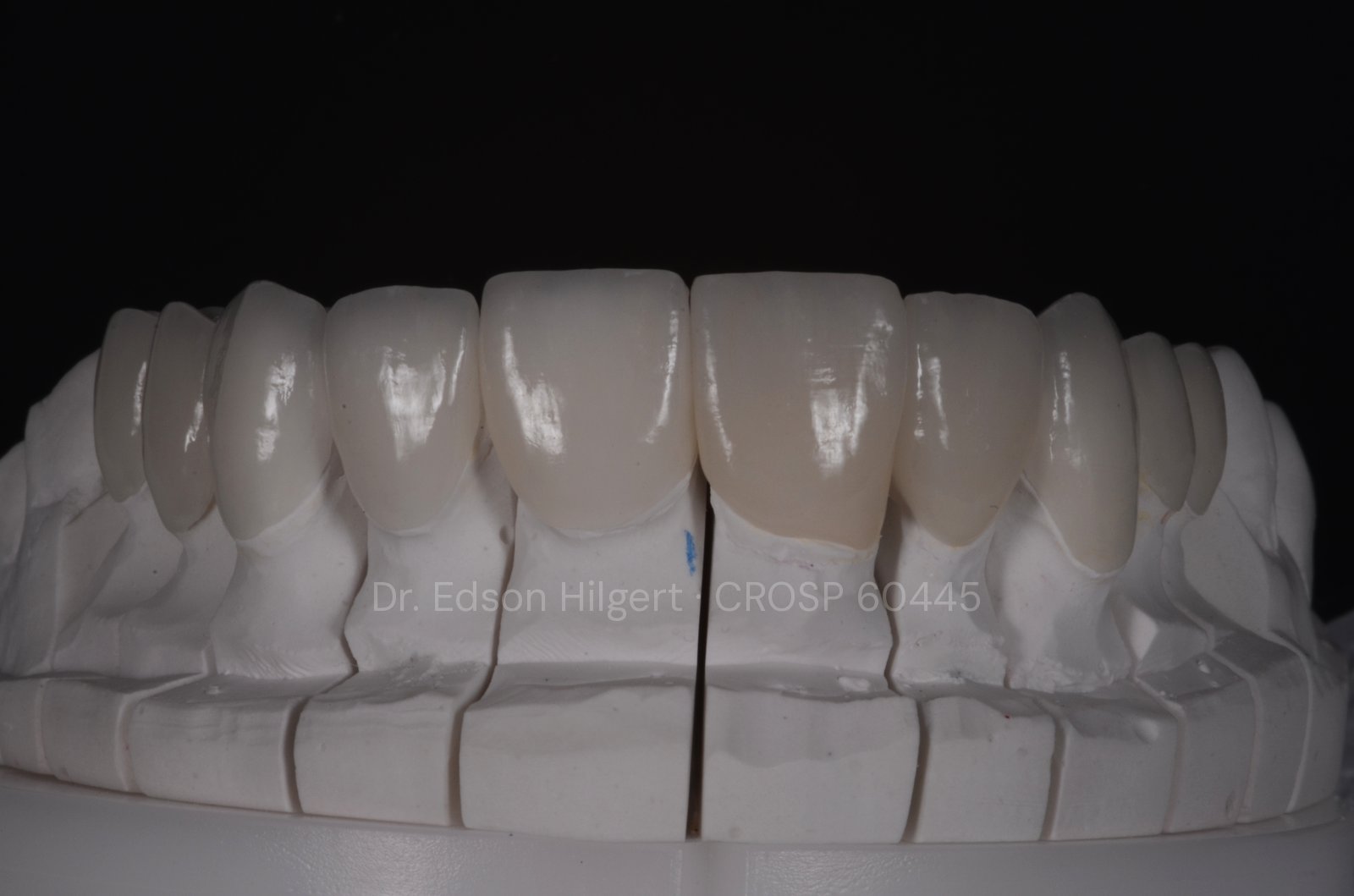 Faceta ou lente de contato dental — laminados cerâmicos — Dr. Edson Hilgert SJC