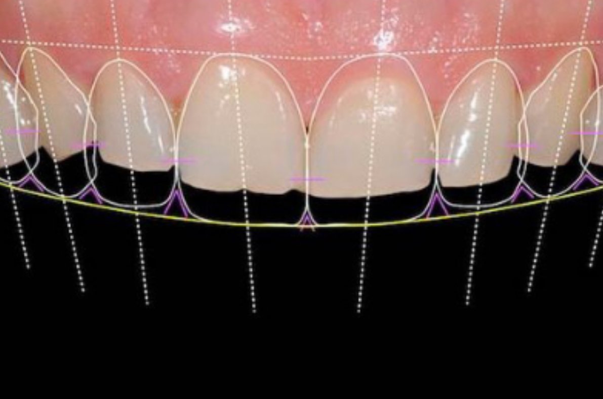 Desenho digital do sorriso — planejamento digital — Dr. Edson Hilgert SJC